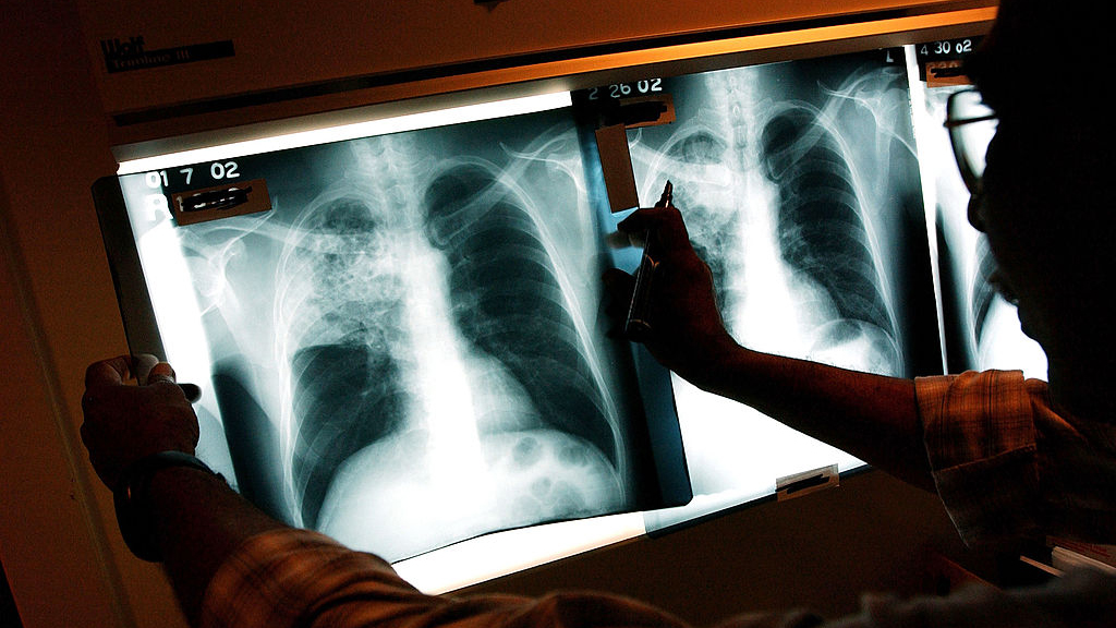 2 active tuberculosis cases traced to San Francisco strip club — KTVU FOX 2 Bay Area, Los Gatos Health news